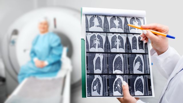 Компьютерная томография с высоким разрешением при фиброзе легких - ключевой инструмент для ранней диагностики