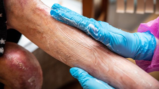 FDA одобрила генную терапию на основе первой и единственной клетки для буллезного эпидермолиза