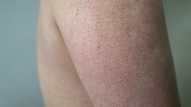 Как справиться с гусиной кожей?