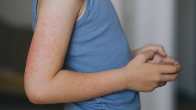 Фотодерматит — требует использования высокого факторного солнцезащитного крема