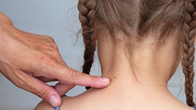 Когда мы должны беспокоиться о родинах или пятнах на коже ребенка?