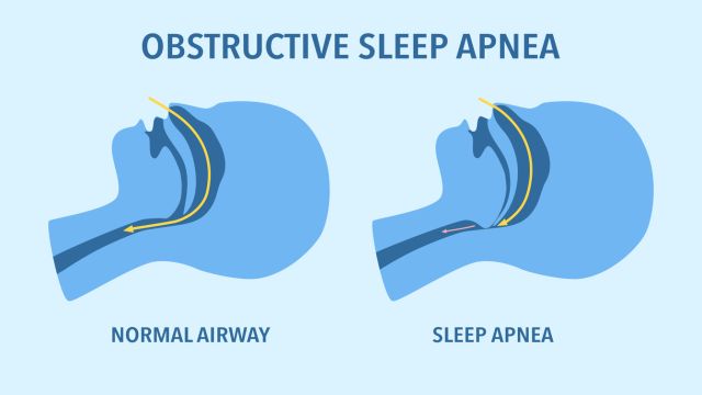 В апноэ во сне более высокий риск сердечно -сосудистых заболеваний