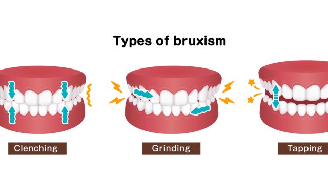 Шлифование с зубами и стрессом — нейробиология бруксизма
