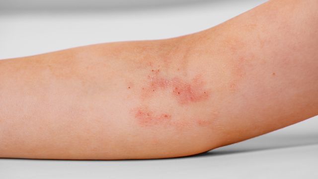 Атопический дерматит — что стоит за упрямым зудом и сухой кожей?