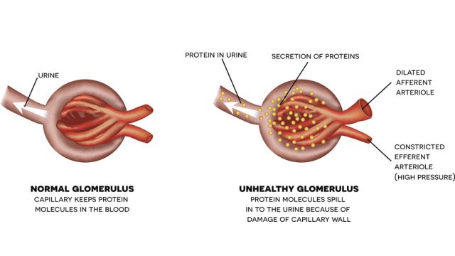Подагряная нефропатия возникает в результате гиперурикемии