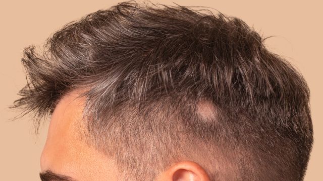 Есть 5 форм алопеции — выпадение волос