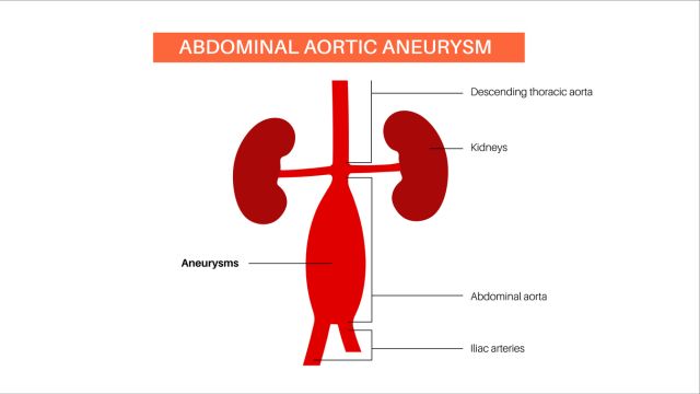 Диагностика визуализации в аневризме аорты