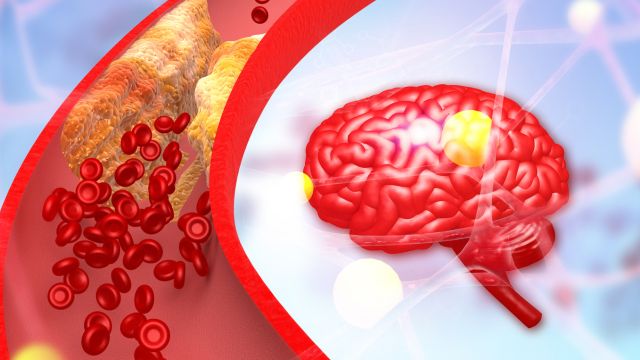 Церебральный атеросклероз - механизмы развития, клинические проявления и профилактика
