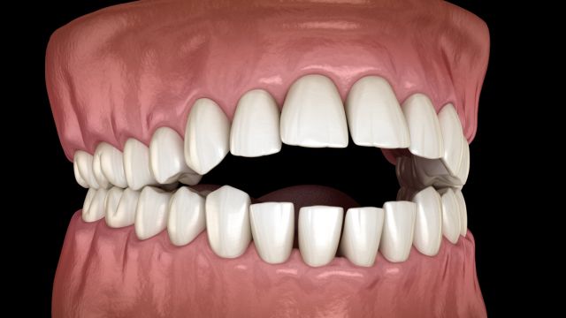 Открытый тип укуса и к каким проблемам он приводит