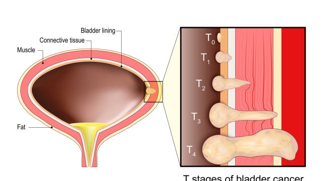 Что такое рак мочевого пузыря?