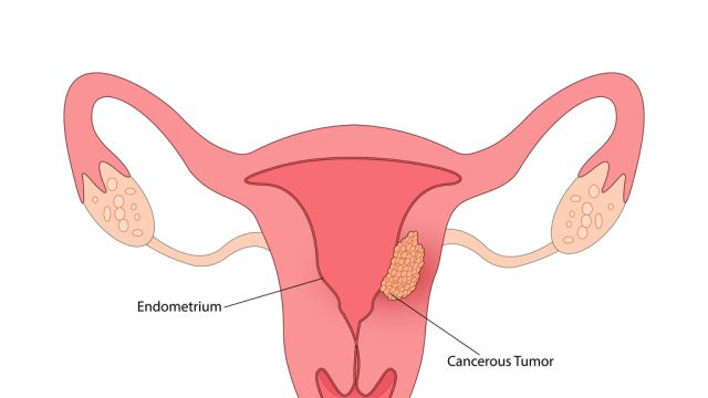 Роль эстрогена в патогенезе карциномы эндометрилании