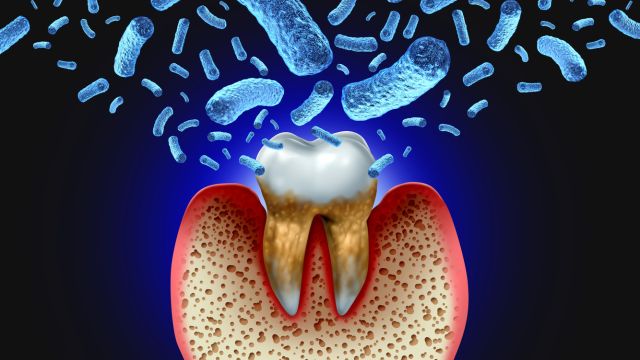 Когда диагностируется пародонтит и как его лечить?