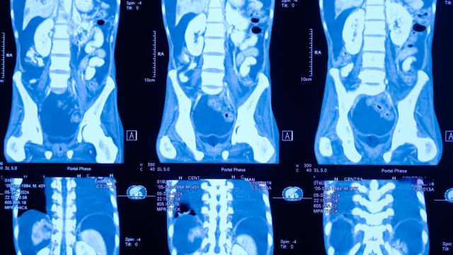 Плевральный выпот – что это может быть?