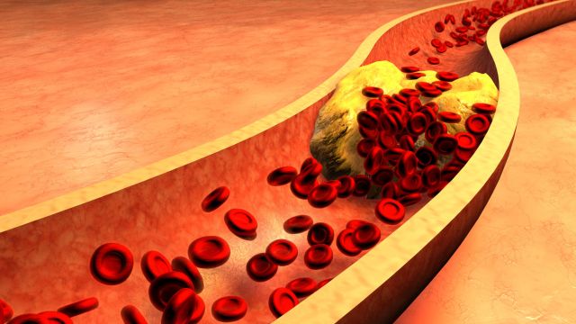 Высокий холестерин является одной из основных причин сердечного приступа и инсульта