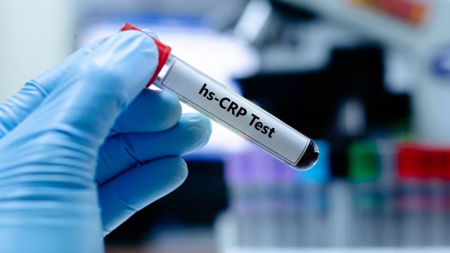 Высокочувствительный C-реактивный белок (HS-CRP)-Что показывает исследование?