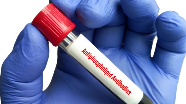 Антифосфолипидные антитела в оценке рецидивирующего тромбоза