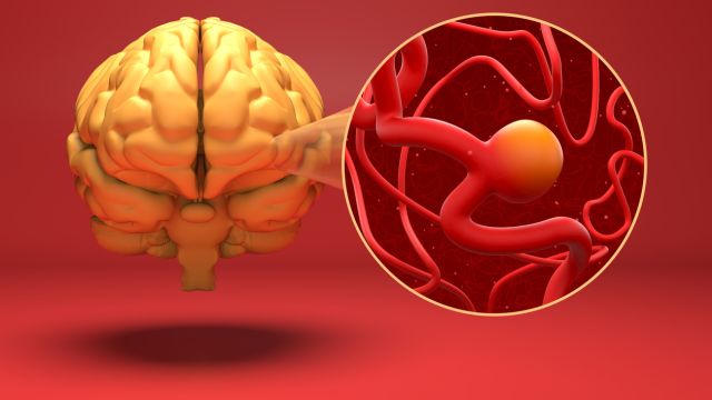 Как формируется аневризма головного мозга и каковы механизмы ее разрыва?