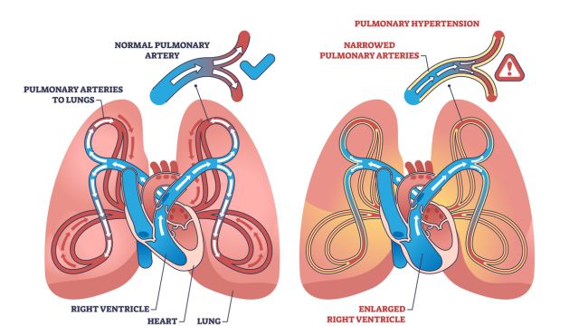 Причины легочной гипертензии