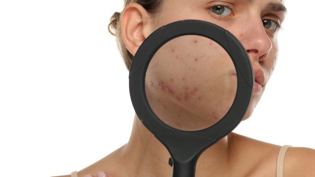 МБАЛ-Пазарджик присоединяется к национальной акции «Вместе в борьбе с акне»