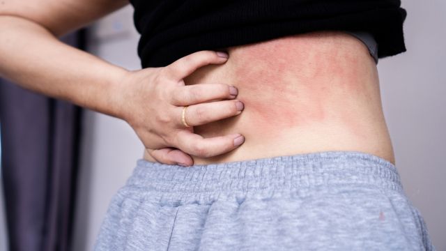 Как справиться с зудом на коже?