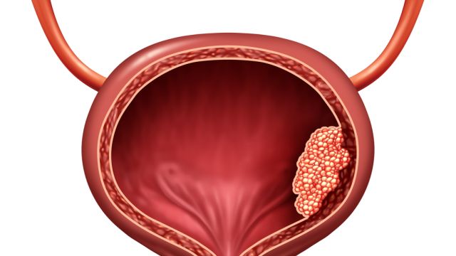 Рак мочевого пузыря: Какие методы лечения предлагает современная медицина, предлагает 2 часть