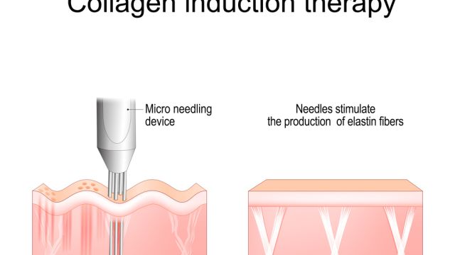 Биостимулирующие наполнители (стимуляторы коллагена) - Где они применимы?