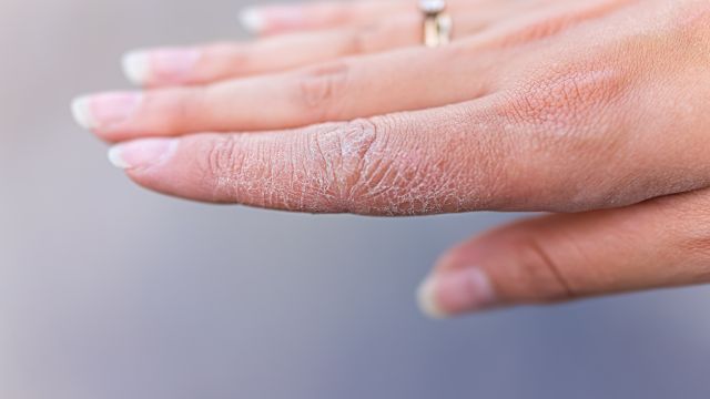 Дисгидроз – странные волдыри на коже.