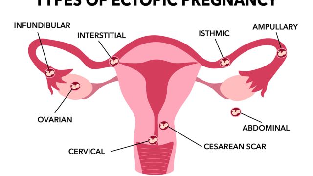 Внематочная беременность – виды и клиническая картина
