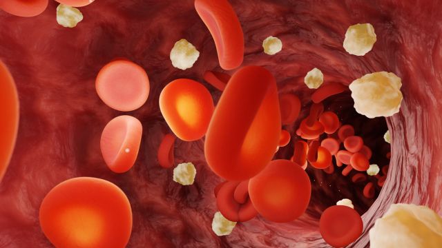 Криоглобулинемический васкулит – воспаление сосудов, связанное с гепатитом С.