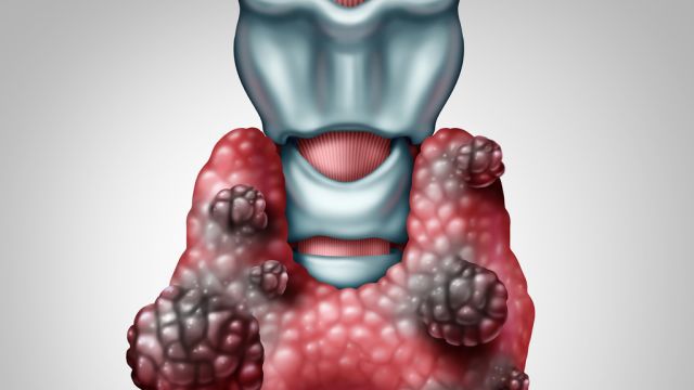 Узлы щитовидной железы и рак – когда стоит беспокоиться?