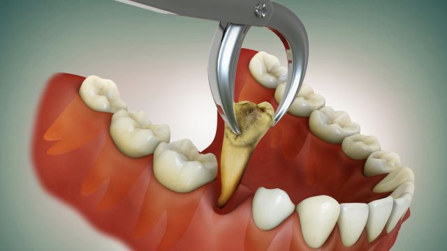 Что делать и чего не делать после удаления зуба?