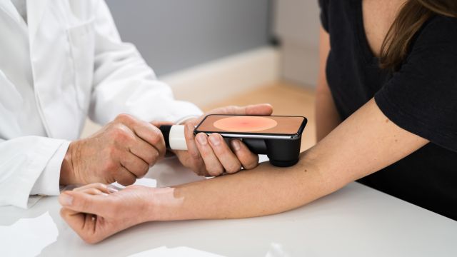 Как искусственный интеллект повышает точность диагностики меланомы?