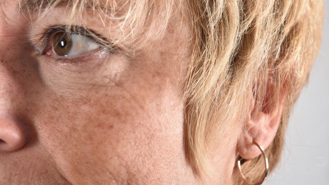 Пигментные пятна на коже – что это такое и как с ними бороться?