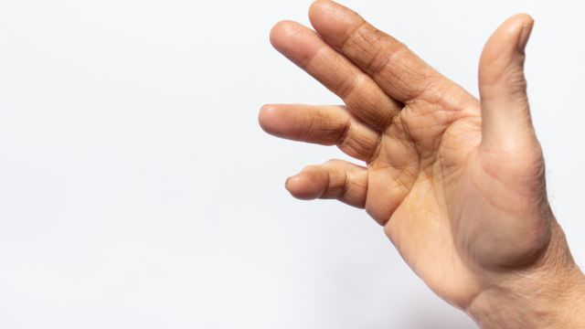 Болезнь Дюпюитрена в пожилом возрасте – проявления и лечение