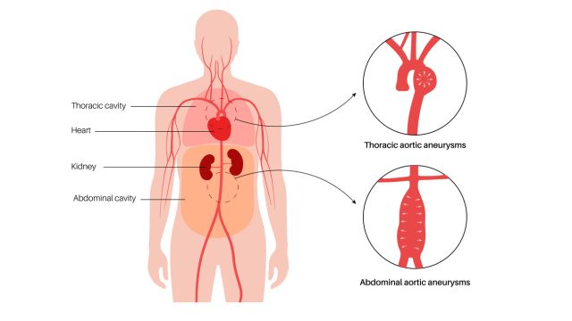 Аневризма грудного отдела аорты – риск разрыва увеличивается с ее размером