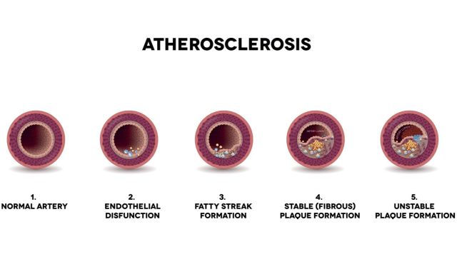 Атеросклероз – мультисистемное сосудистое заболевание с неблагоприятными последствиями.