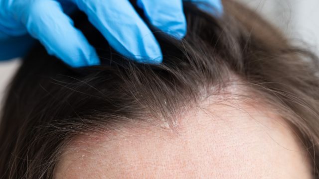 Себорейный дерматит – обостряется ли зимой?