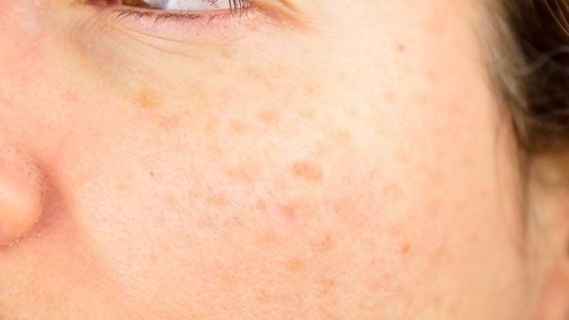 Почему появляются пигментные пятна при беременности?