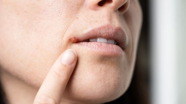 Вирус простого герпеса – часто реактивируется при простуде и стрессе.