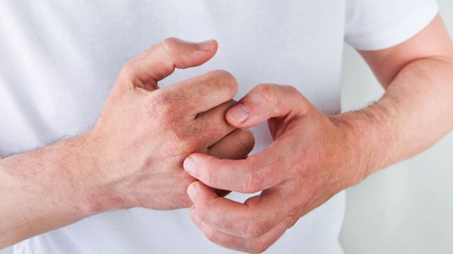 Экзема рук и как на нее влияет зимнее время года?