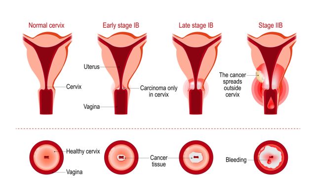 Методы лечения дисплазии шейки матки