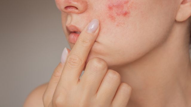 Как успокоить раздраженную кожу лица?