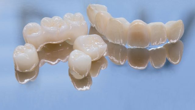 Преимущества и недостатки керамических конструкций в полости рта