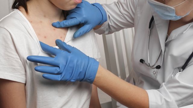 Ветрянка – одно из самых заразных заболеваний