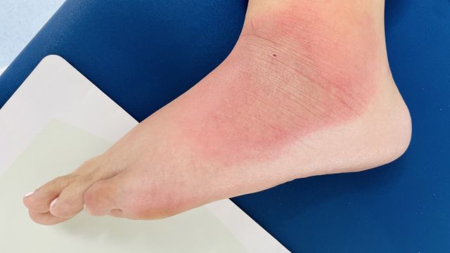 Рожа – в чем причина появления?