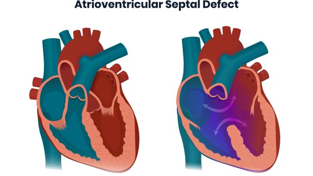 Дефект атриовентрикулярной перегородки при синдроме Дауна – почему он так распространен?