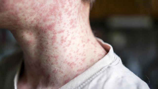 Корь – одно из самых заразных вирусных заболеваний