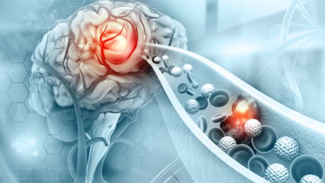 Как оценивается риск инсульта после транзиторной ишемической атаки?