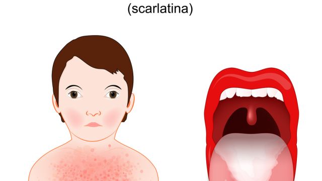 Скарлатина – на что обратить внимание после перенесенного заражения и натуропатические решения