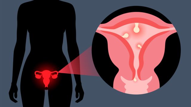 Когда следует лечить миомы?